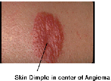 Skin Dimple